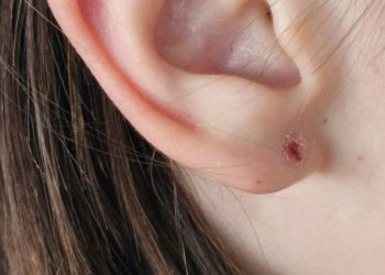 Close-up of an ear with an infected piercing