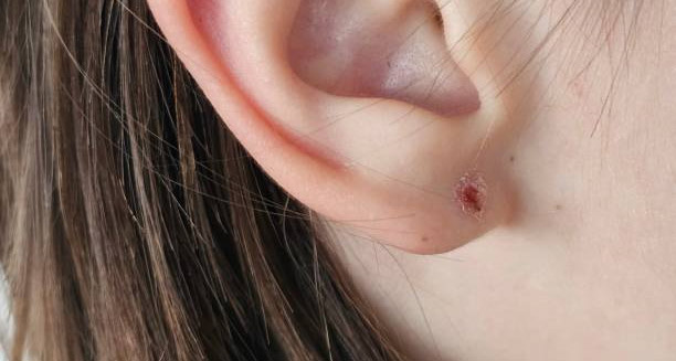 Close-up of an ear with an infected piercing
