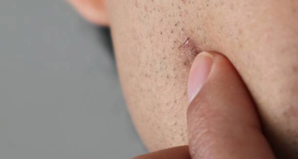 Ingrown Hairs