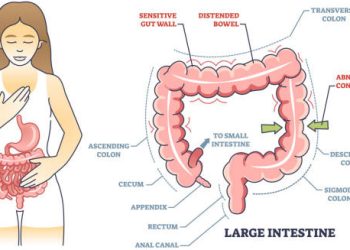Illustration of irritable bowel syndrome showing large intestine anatomy and symptoms like distended bowel and abnormal contractions
