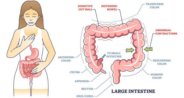 Illustration of irritable bowel syndrome showing large intestine anatomy and symptoms like distended bowel and abnormal contractions