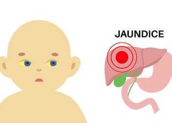 Illustration of a newborn with yellow eyes and a diagram of the liver indicating jaundice