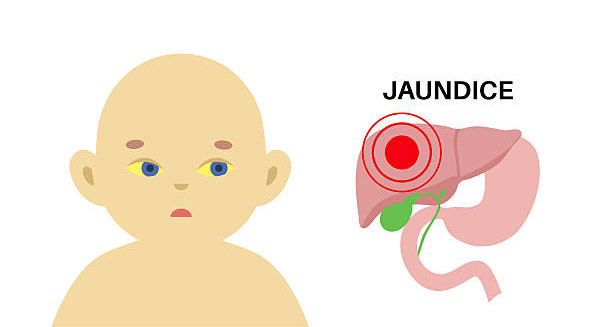 Illustration of a newborn with yellow eyes and a diagram of the liver indicating jaundice
