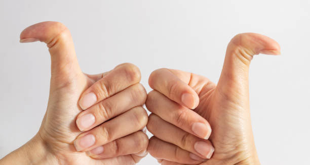 Close-up of hyperextended thumbs showing signs of joint hypermobility syndrome