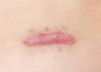 Close-up image of a raised, pink keloid scar on human skin