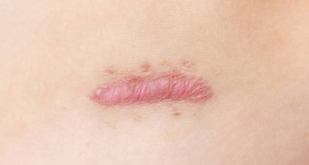 Close-up image of a raised, pink keloid scar on human skin
