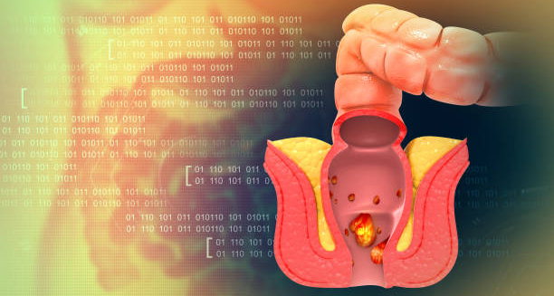 Haemorrhoids Prognosis and Long-Term Outlook