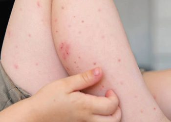 Child with Henoch-Schönlein Purpura rash on legs indicating recovery outlook