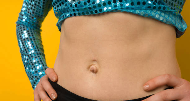 Close-up of a woman's abdomen with an umbilical hernia visible