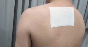 Medical bandage on a person’s upper back after hidradenitis suppurativa treatment