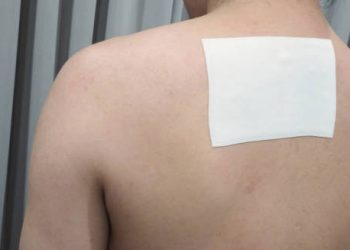 Medical bandage on a person’s upper back after hidradenitis suppurativa treatment