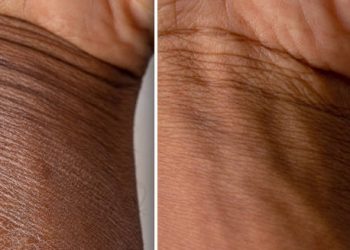Side-by-side comparison of dry and treated skin on a person’s wrist affected by ichthyosis.