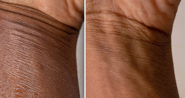 Side-by-side comparison of dry and treated skin on a person’s wrist affected by ichthyosis.