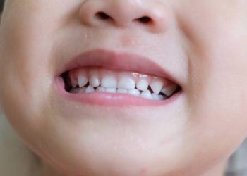 Close-up of a child’s mouth showing healing skin from impetigo infection