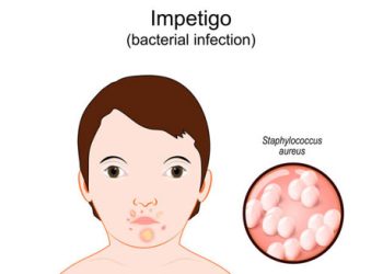 Illustration of impetigo bacterial infection on a child's face