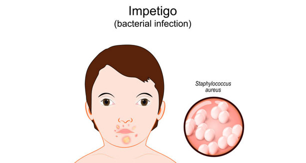 Illustration of impetigo bacterial infection on a child's face