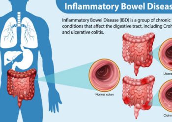 Diagram illustrating the digestive tract and types of inflammatory bowel disease, including Crohn’s disease and ulcerative colitis.