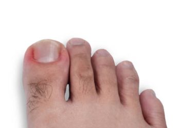 Overview of Ingrown Toenail