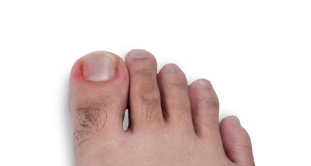 Overview of Ingrown Toenail