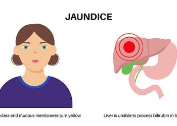 Illustration of a woman with yellow eyes and a diagram of the liver showing jaundice due to bilirubin buildup