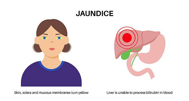 Illustration of a woman with yellow eyes and a diagram of the liver showing jaundice due to bilirubin buildup