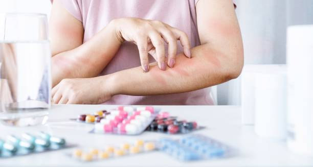 Person scratching red allergic rash on arm with allergy medications on the table