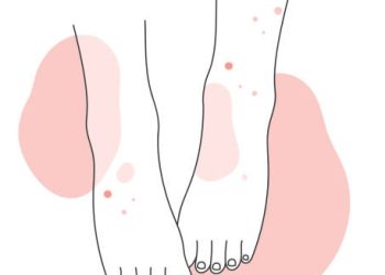 Illustration of legs with skin rash indicating Henoch-Schönlein Purpura prevention awareness