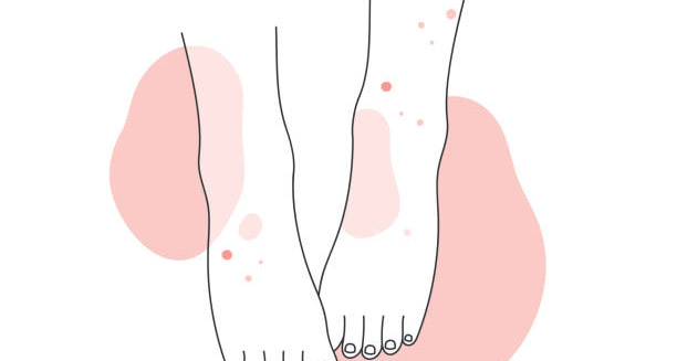 Illustration of legs with skin rash indicating Henoch-Schönlein Purpura prevention awareness