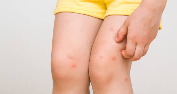 Child scratching red itchy bumps on legs from food allergy reaction