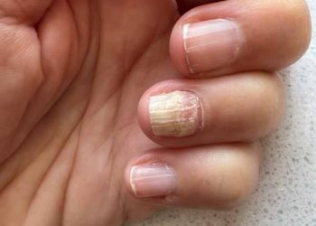 Close-up of a hand with a thickened, discoloured fingernail caused by fungal infection