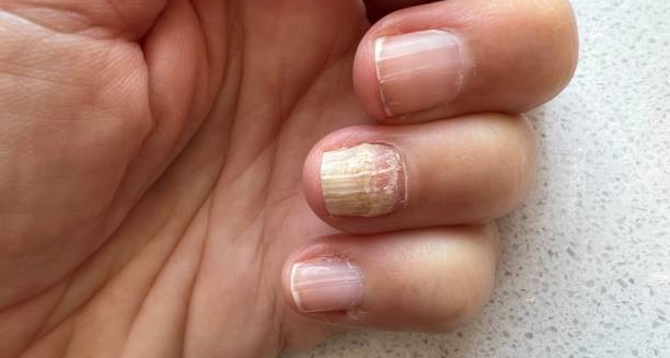 Close-up of a hand with a thickened, discoloured fingernail caused by fungal infection