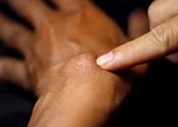 Finger pointing at a lump on the wrist, indicating a ganglion cyst