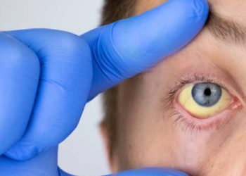 Yellowing of the eye in person with Gilbert’s Syndrome