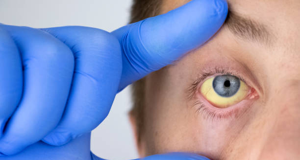 Yellowing of the eye in person with Gilbert’s Syndrome