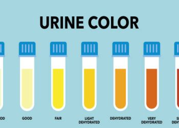 Urine colour scale indicating dehydration and possible glomerulonephritis symptoms