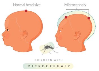 Illustration comparing normal head size to microcephaly in children