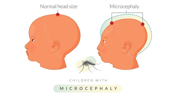 Illustration comparing normal head size to microcephaly in children