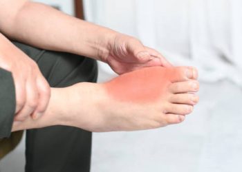Person holding red, inflamed foot due to gout symptoms