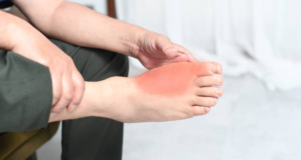 Person holding red, inflamed foot due to gout symptoms