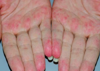 Red rash and inflammation on palms due to granulomatosis with polyangiitis