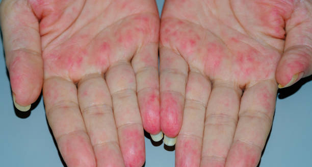 Red rash and inflammation on palms due to granulomatosis with polyangiitis