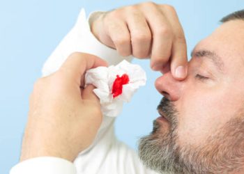 Man pinching nose with tissue showing a nosebleed