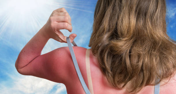Woman with red, irritated skin on shoulders showing symptoms of heat rash after sun exposure