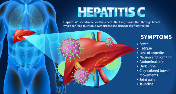 Medical illustration showing liver symptoms and complications of hepatitis C
