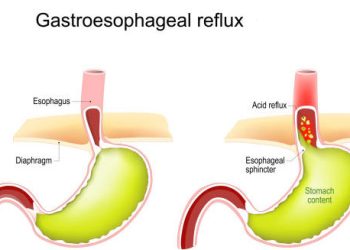 Diagram showing gastroesophageal reflux, a common symptom of hiatus hernia