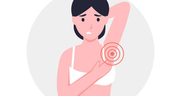 Illustration of a woman with pain and swelling in the underarm, indicating symptoms of hidradenitis suppurativa