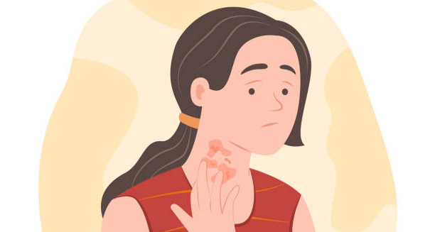 Illustration of a woman scratching red itchy hives on her neck