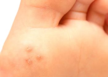 Symptoms of Human Papillomavirus