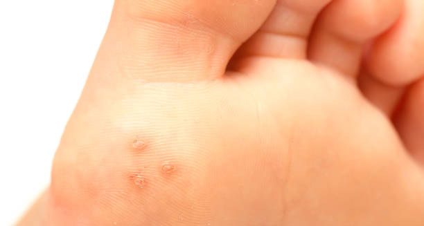 Symptoms of Human Papillomavirus