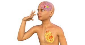 Symptoms of Huntington’s Disease